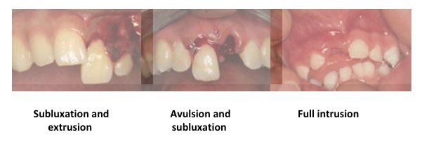 Loose or displaced teeth   Injury   Examination findings   Management 